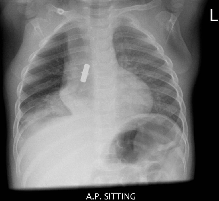 Inhalational Emergency • LITFL • Clinical Cases Paediatric