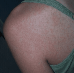 Herman S Rash Fever, Arthralgia and Rash • LITFL • Tropical Traveler Clinical Case