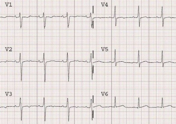 Sinus Rhythm T Wave Inversion Online | vivatumusica.com