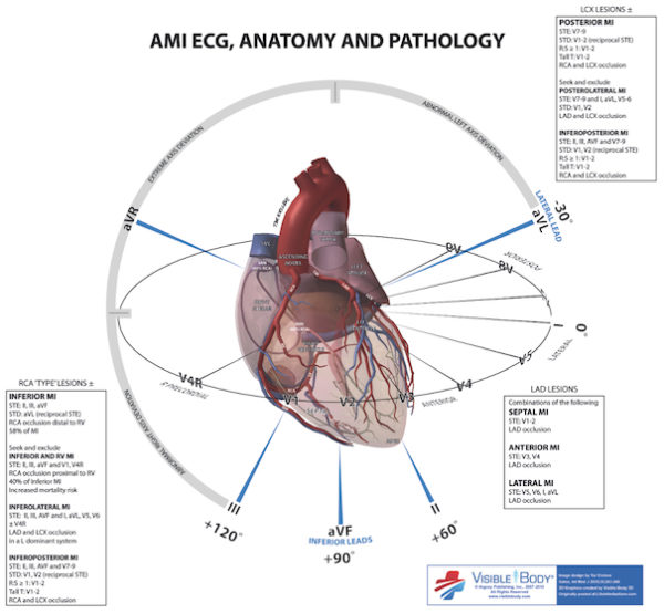 ECG Anatomy MI localisation