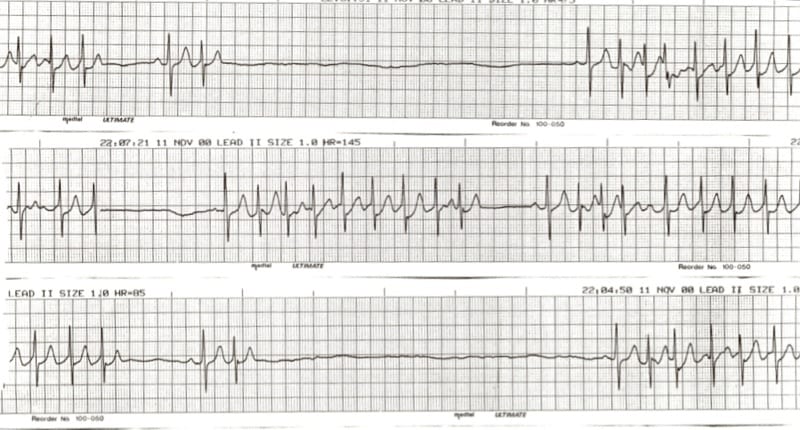 ekg rhythm strips