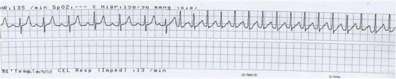 ECG Rhythm strip Exigency 003 2