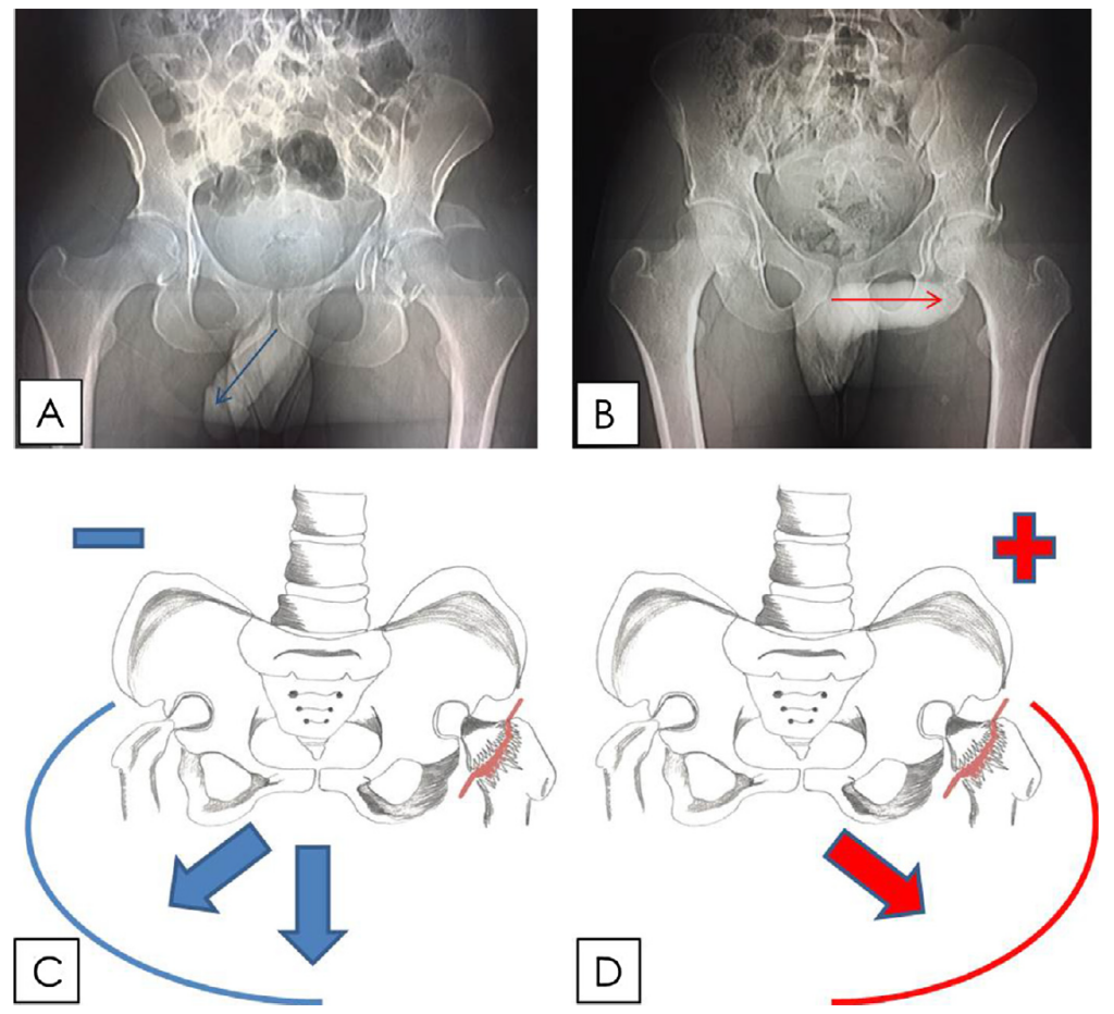 Gerber et al. Journal of Clinical Orthopaedics and Trauma 2017 John Thomas sign