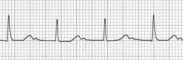 The T-Wave Explained - What Do T Waves On An ECG Represent?