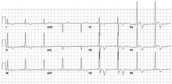 T wave • LITFL • ECG Library Basics