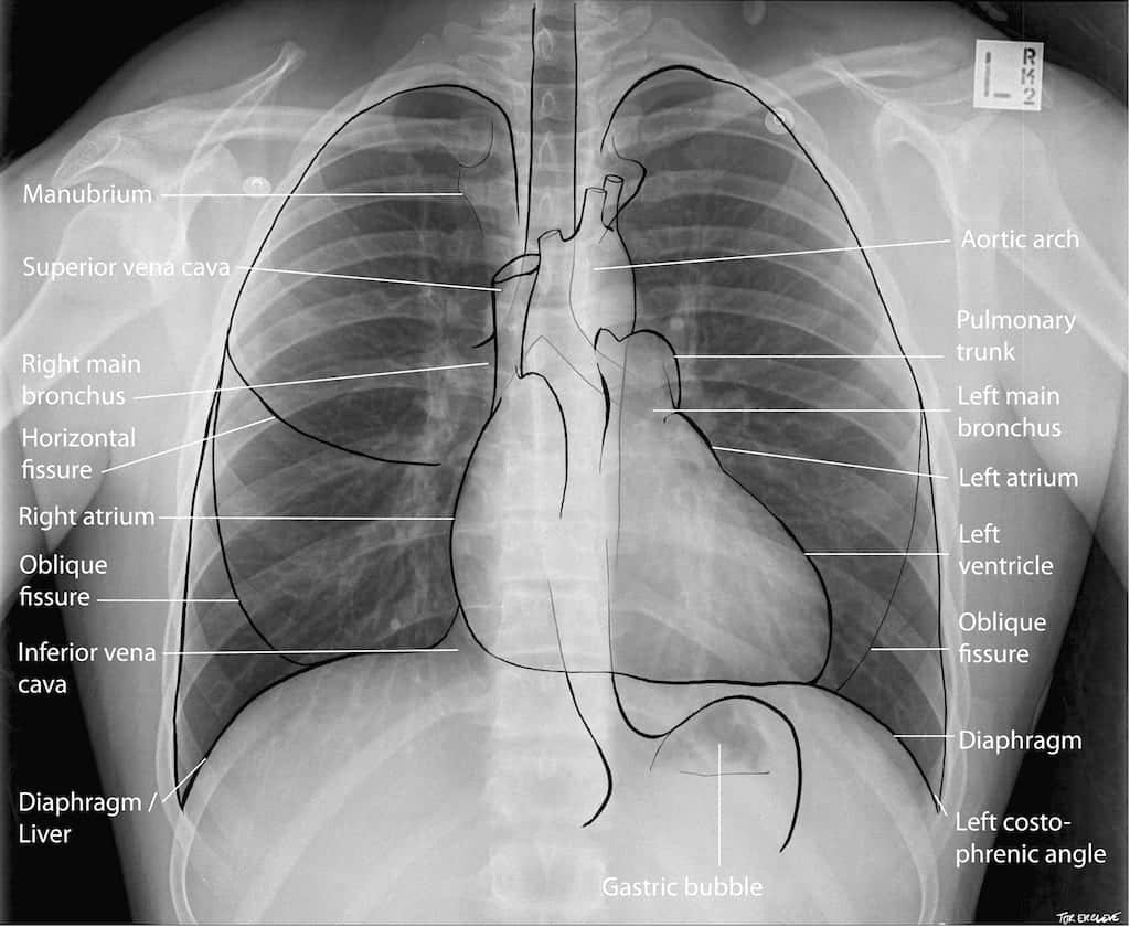 Normal Chest X Ray LITFL Medical Blog Labelled Radiology