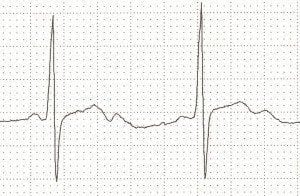 T wave • LITFL • ECG Library Basics