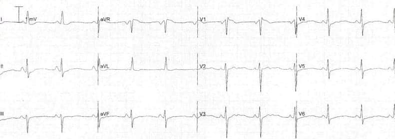 T wave • LITFL • ECG Library Basics