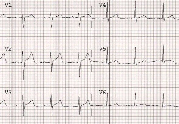 T Wave Elevation