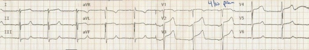 TOP 100 ECG QUIZ LITFL 005 3