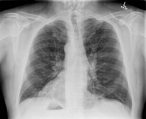 Top 100 CXR LITFL 002