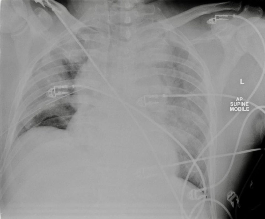 Trauma tribulation 034 CXR