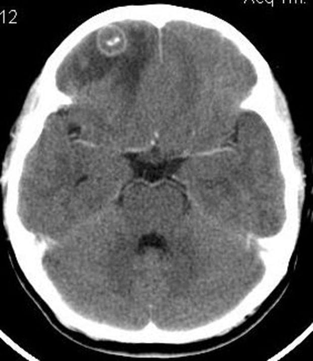 intracranial tuberculoma