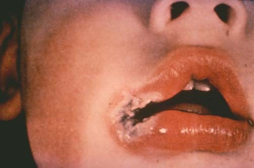 Hot lips LITFL Clinical Cases Trauma Tribulation