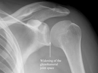 xray shoulder dislocation