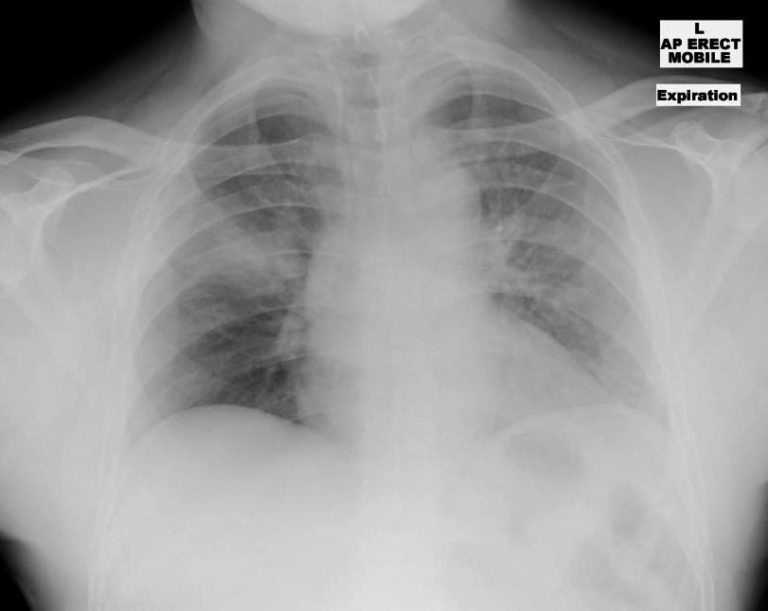 stab-clavicle-CXR-1-768x611.jpeg