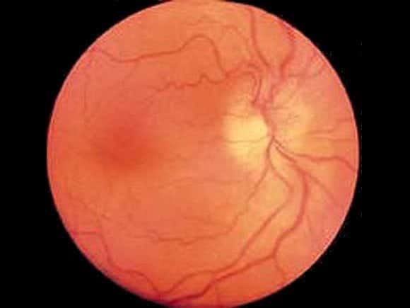 Anterior ischemic optic neuropathy AION