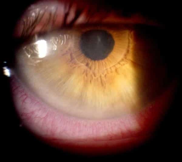 acute uveitis