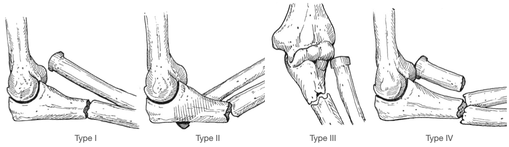 Bado-Classification-of-Monteggia Type I-IV