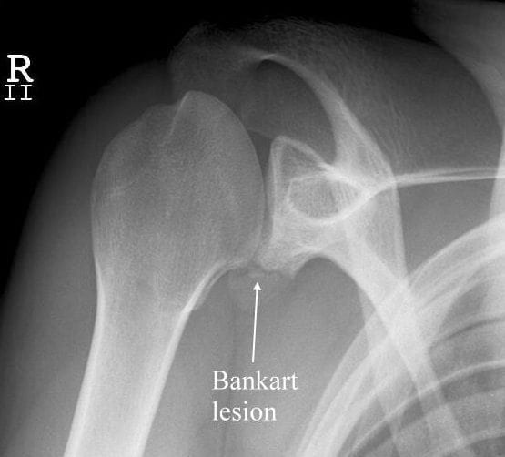Bankart Fracture What Is A Bankart Lesion Signs Symptoms And Bankart Fracture What Is A Bankart Lesion Signs Symptoms And