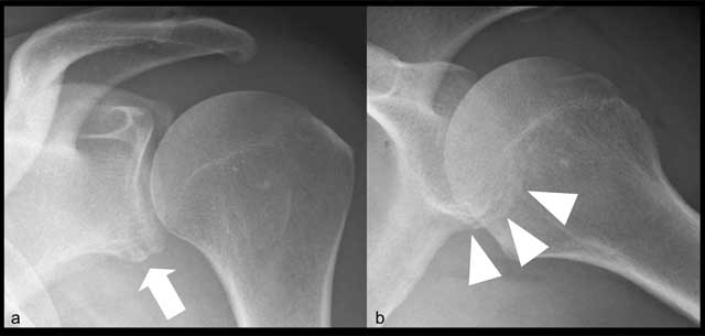 Bony-Bankhart-lesion