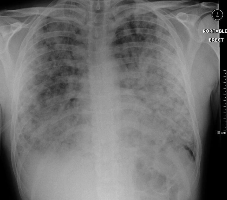 Rapid descent • LITFL • Pulmonary Puzzler