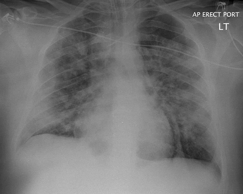 CXR Pulmonary Puzzler 001