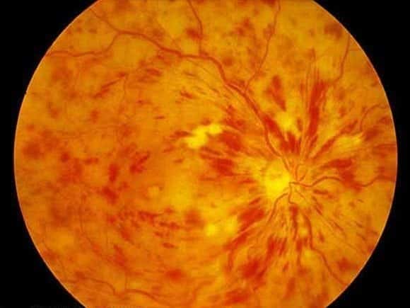 Central retinal vein occlusion (CRVO)