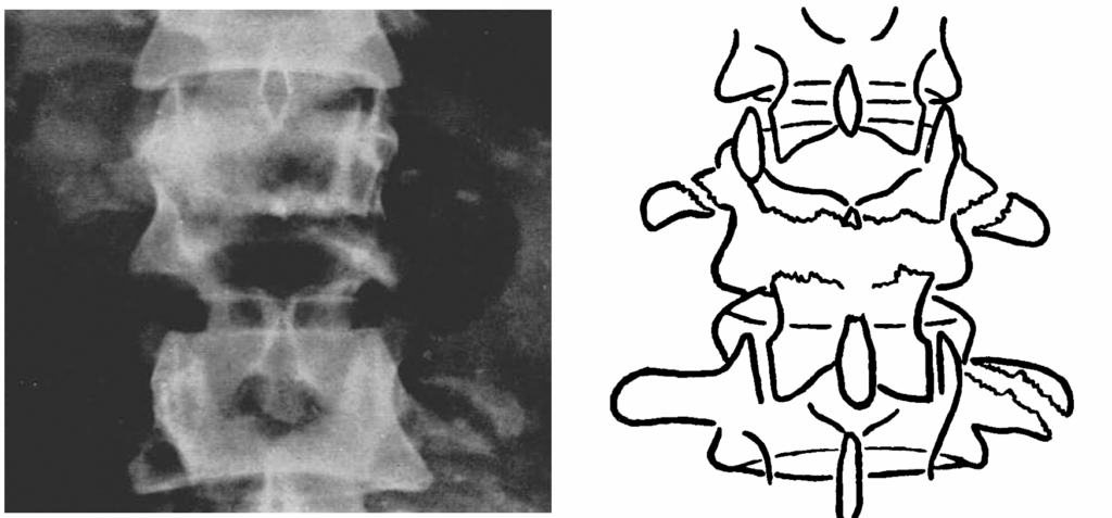 Chance fracture GQ chance 1948 AP