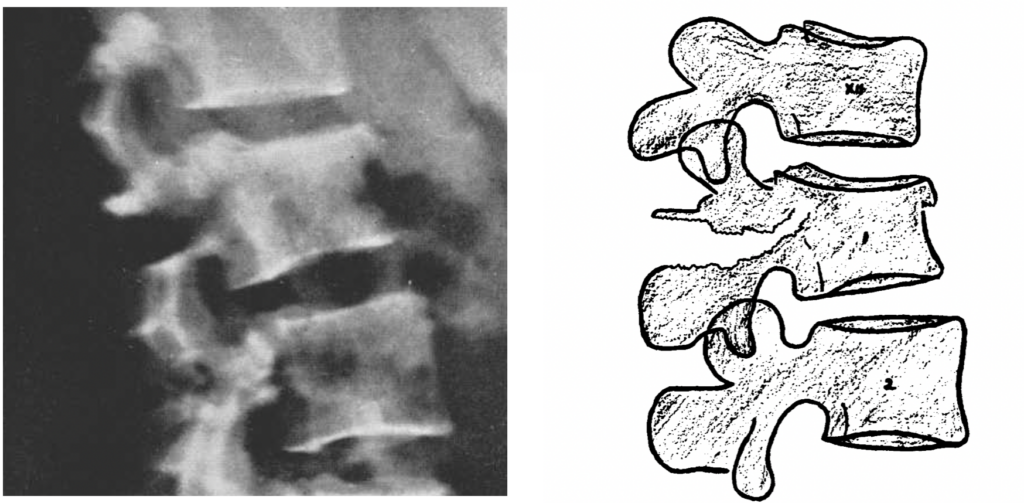 Chance fracture GQ chance 1948 lateral