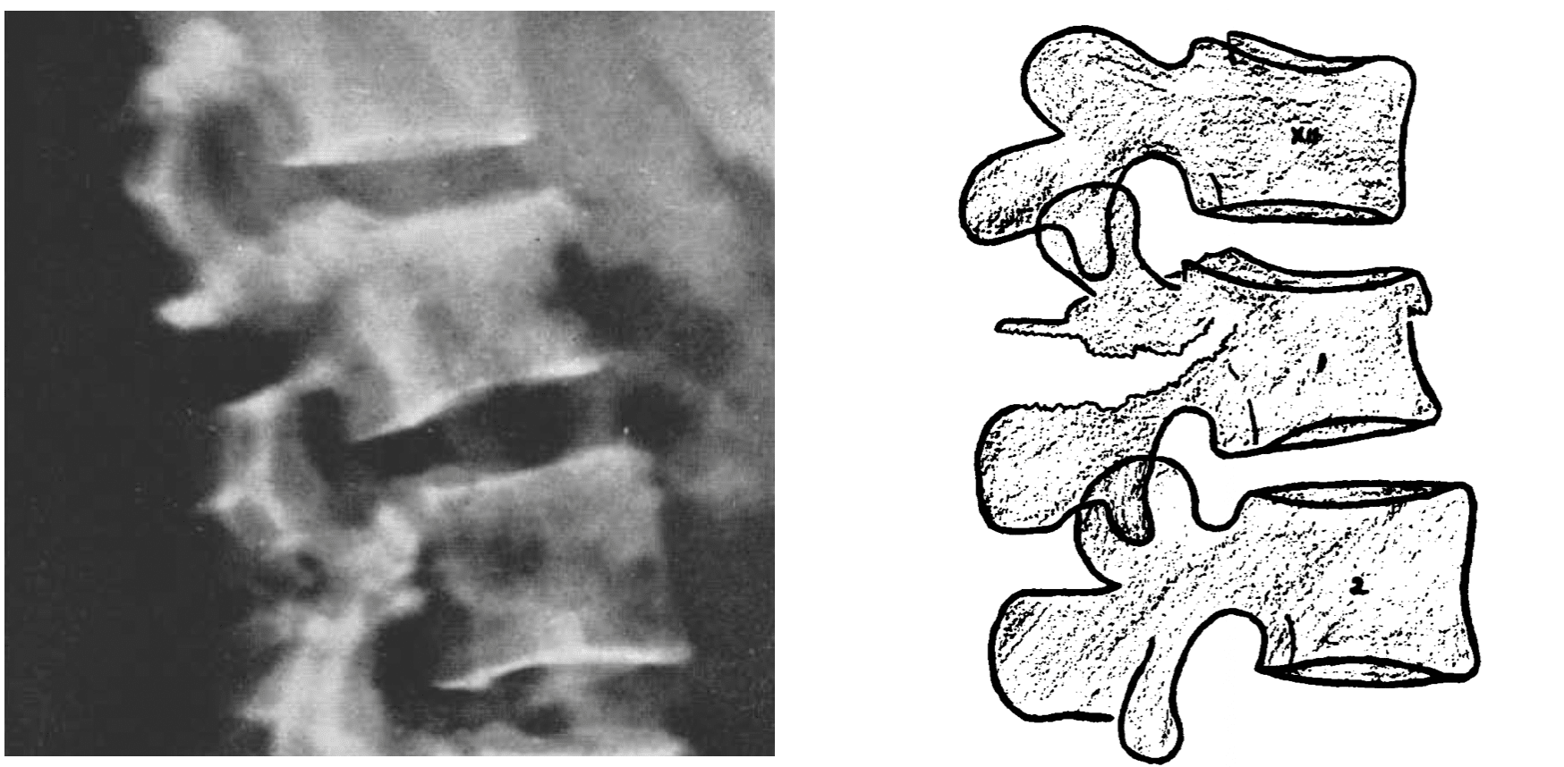 chance fracture seat belt