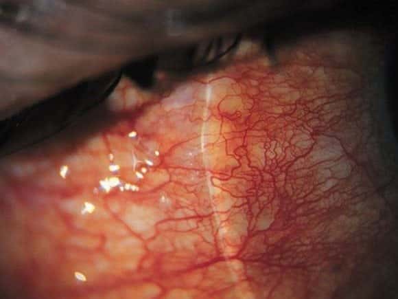 Conjunctival injection Injected conjunctival vessels