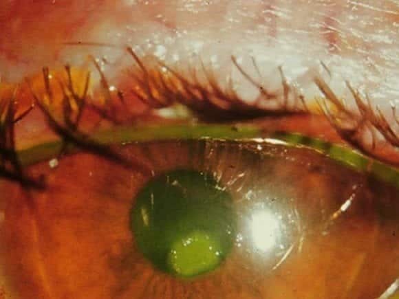 scleral abrasion fluorescein