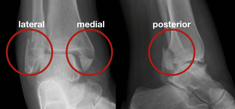 left trimalleolar ankle fractures dislocations