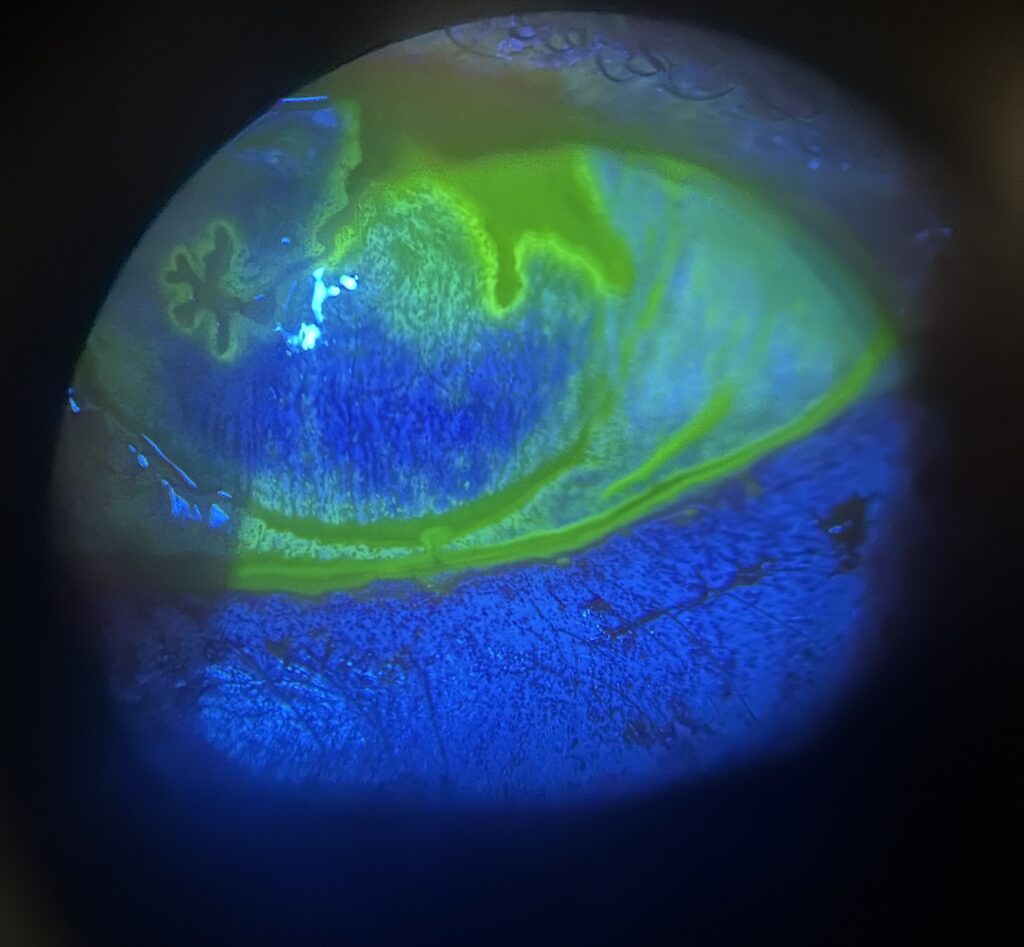Dendritic ulcer Herpes simplex keratitis