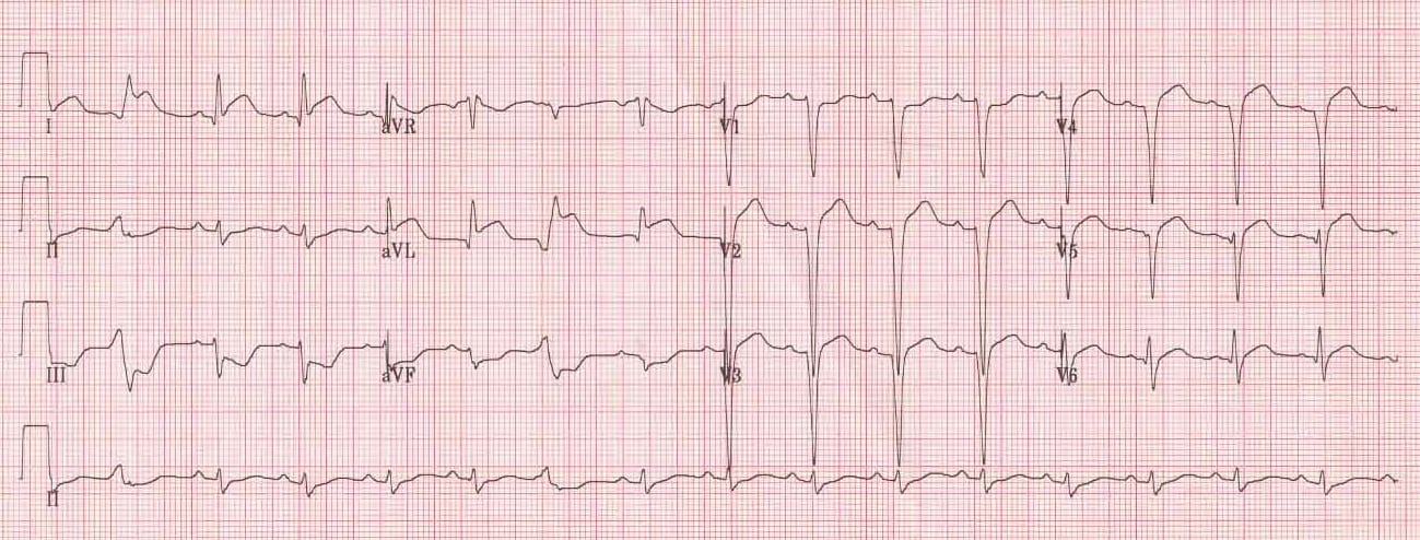 Lateral Myocardial Infarction Ecg