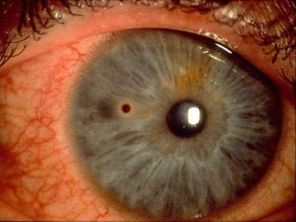 corneal rust ring