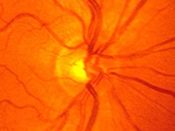 EYE Normal Optic Disc