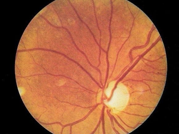 EYE Optic Atrophy Primary