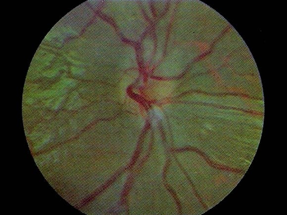 EYE Optic Neuritis