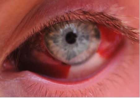 EYE Subconjunctival hemorrhage