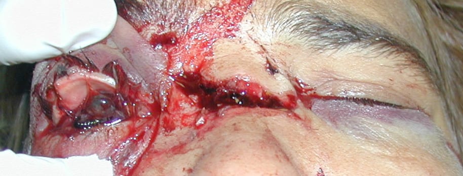 split laceration