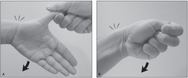 de quervain s syndrome test finkelstein)