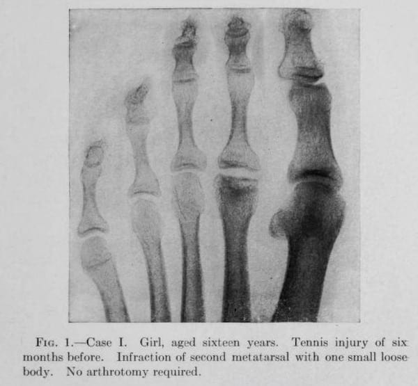 Freiberg original description (case 1903, lecture 1913, published 1914)