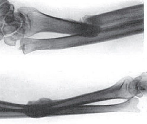 therapy galeazzi fracture