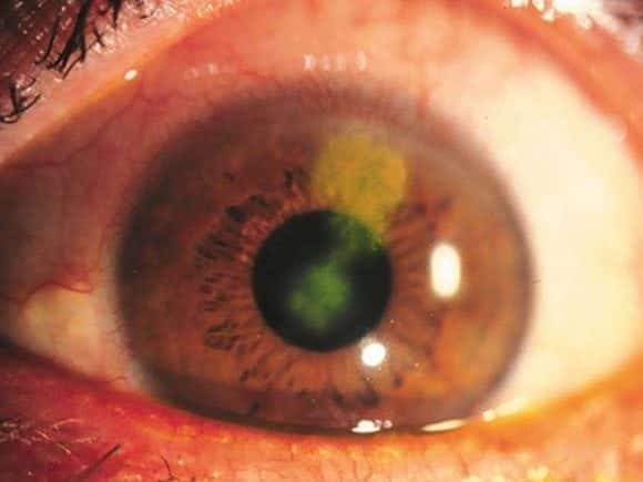 Herpes simplex keratitis dendritic ulcer