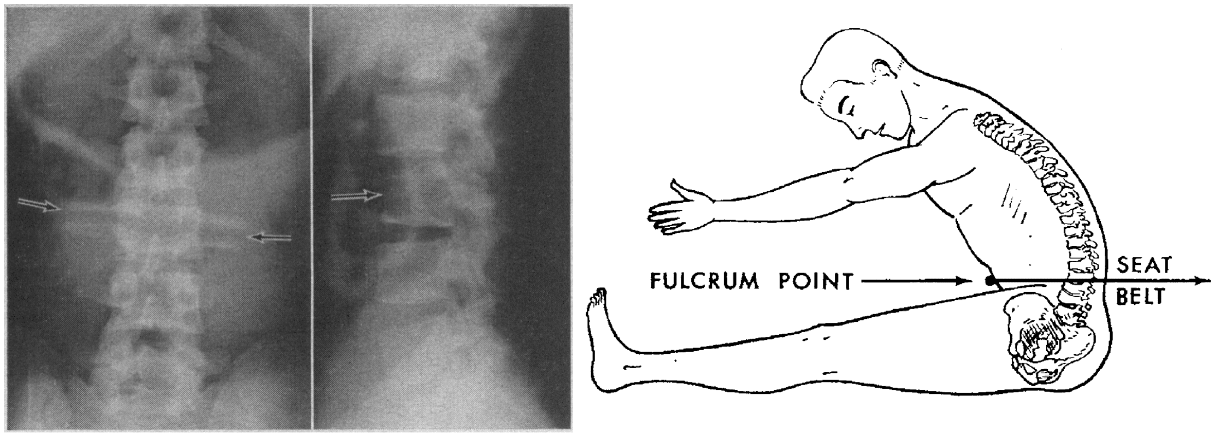 Chance Fracture LITFL Medical Blog Medical Eponym Library