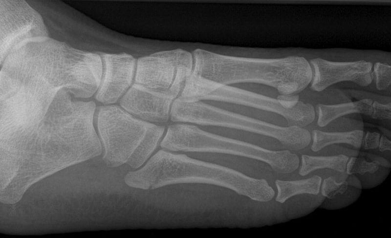 metatarsal fracture