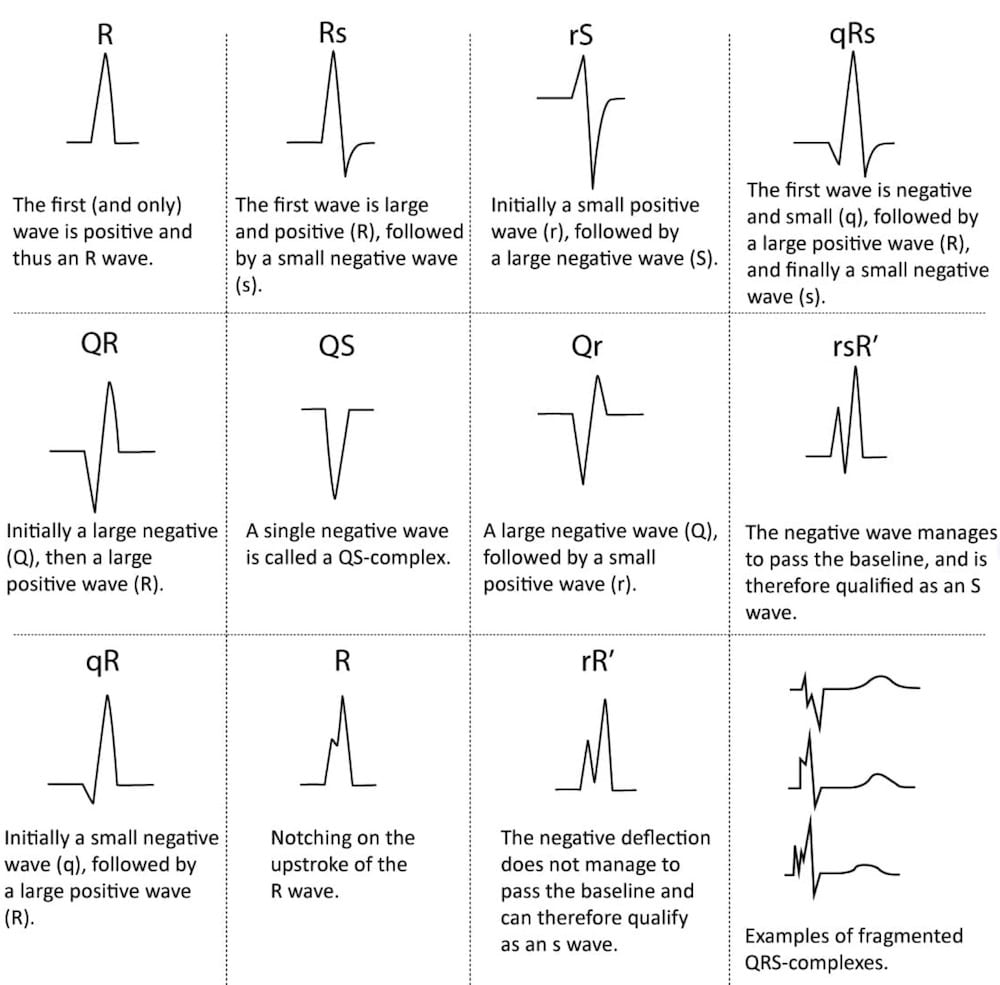 QRS Interval LITFL ECG Library Basics