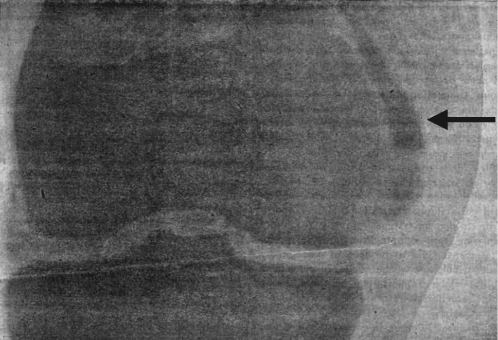 Pellegrini 1905 calcification of the tibial collateral ligament